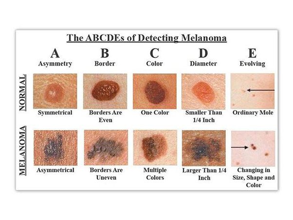 autoesame melanoma